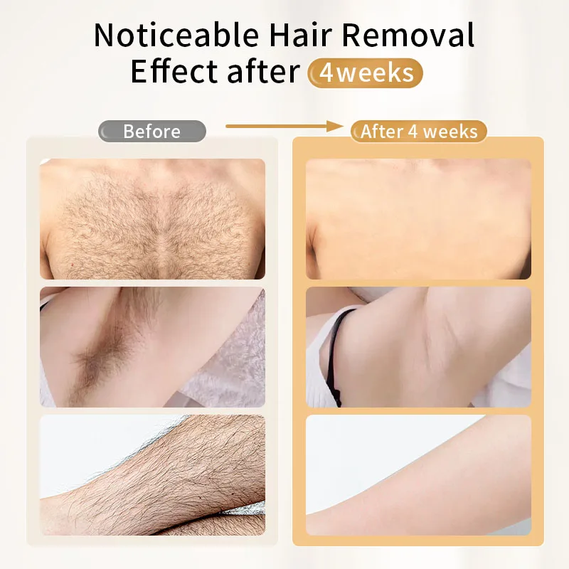 Dispositivo de Depilação a Las - Ipl Hair Removal Handset Permanent avaliação e preço