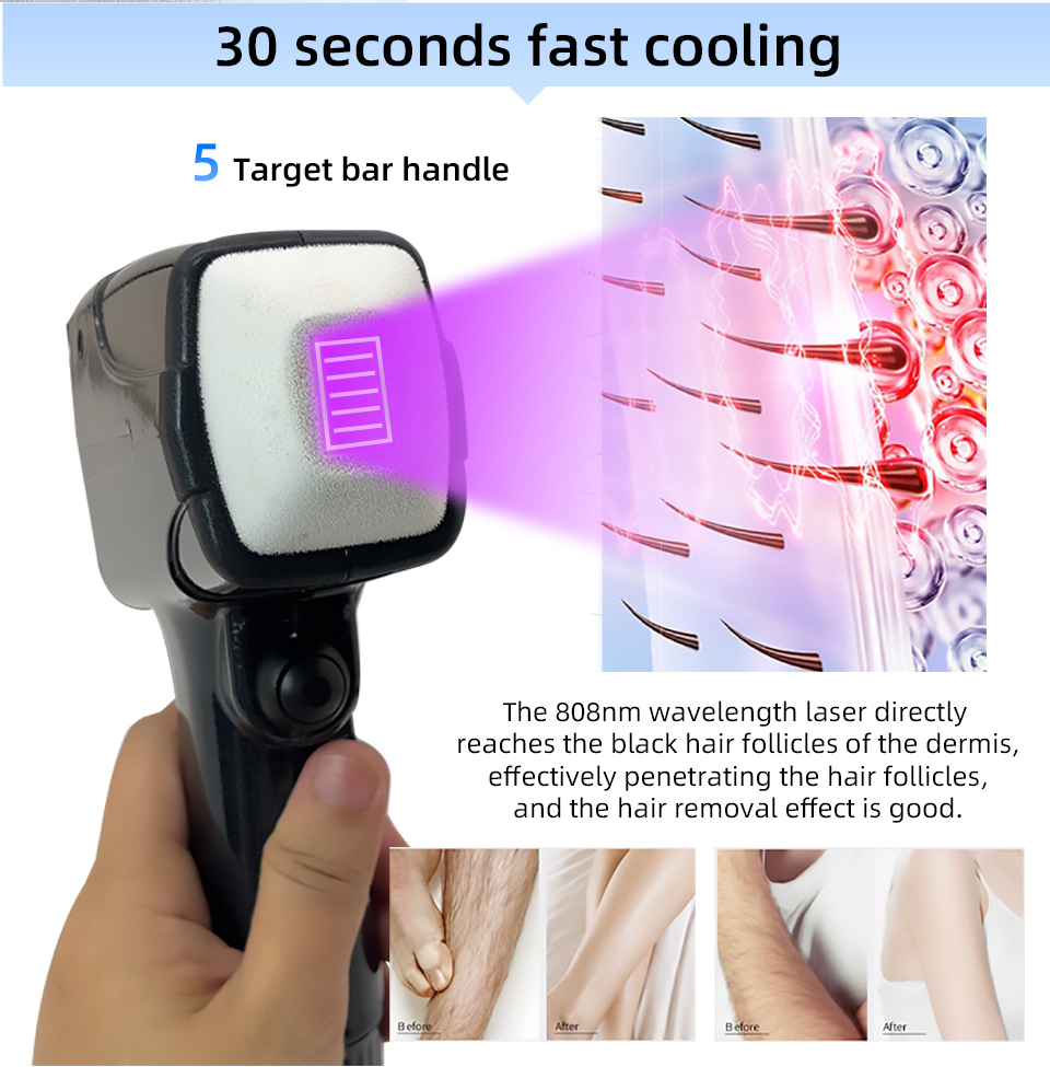 Novo Estilo de Laser Diodo Por - Alexandrite Laser Hair Removal Machine avaliação e preço